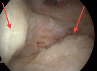 Elbow Malunion Impingement